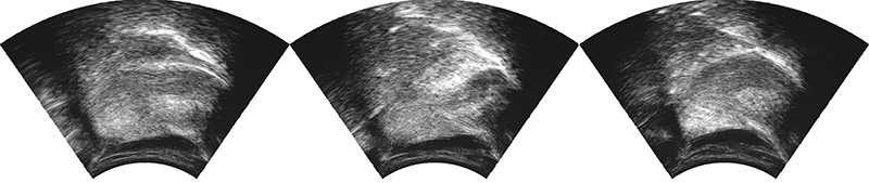 Swallow Vision Ultrasound