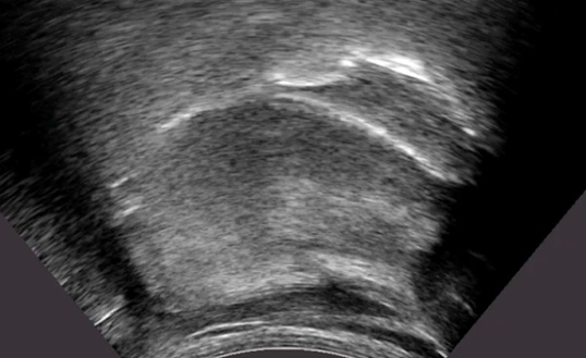 UltraSound Evaluation of Swallowing