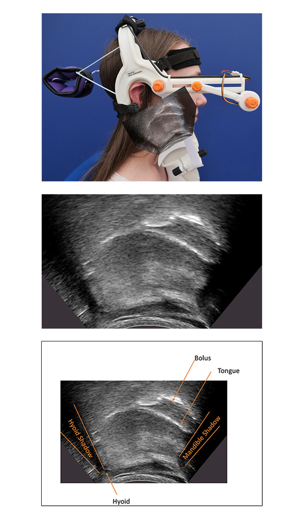 UltraSound Evaluation of Swallowing